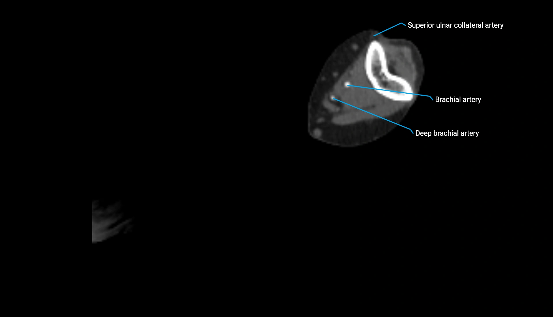 CTA upper limb axial cross sectional anatomy labelled image 199 (2).webp